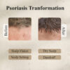 Psorakit Ayurvedic Psoriasis Shampoo