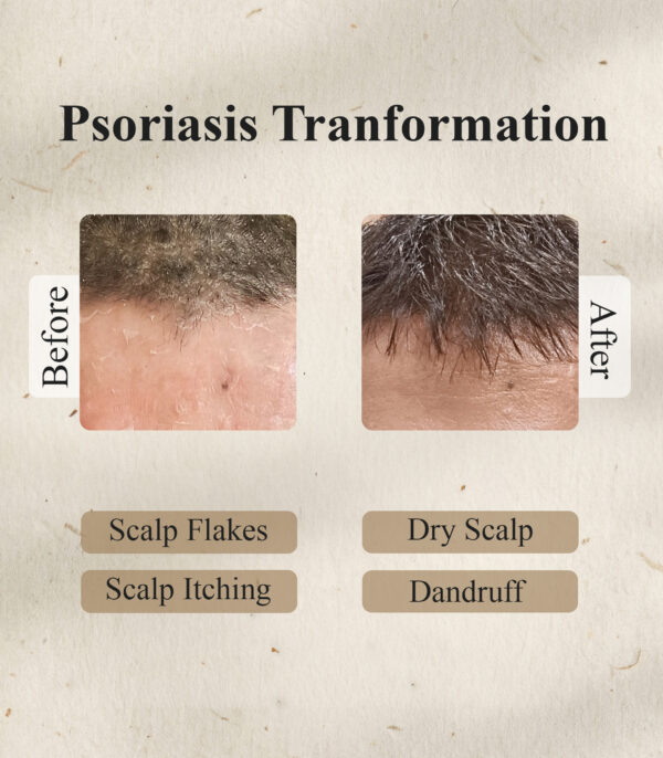 Psorakit Ayurvedic Psoriasis Shampoo